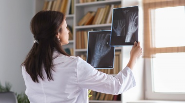 Osteoporosis, cómo cuidar nuestros huesos
